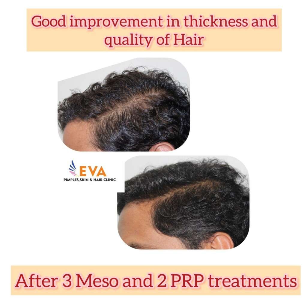 Hair loss Treatment Results