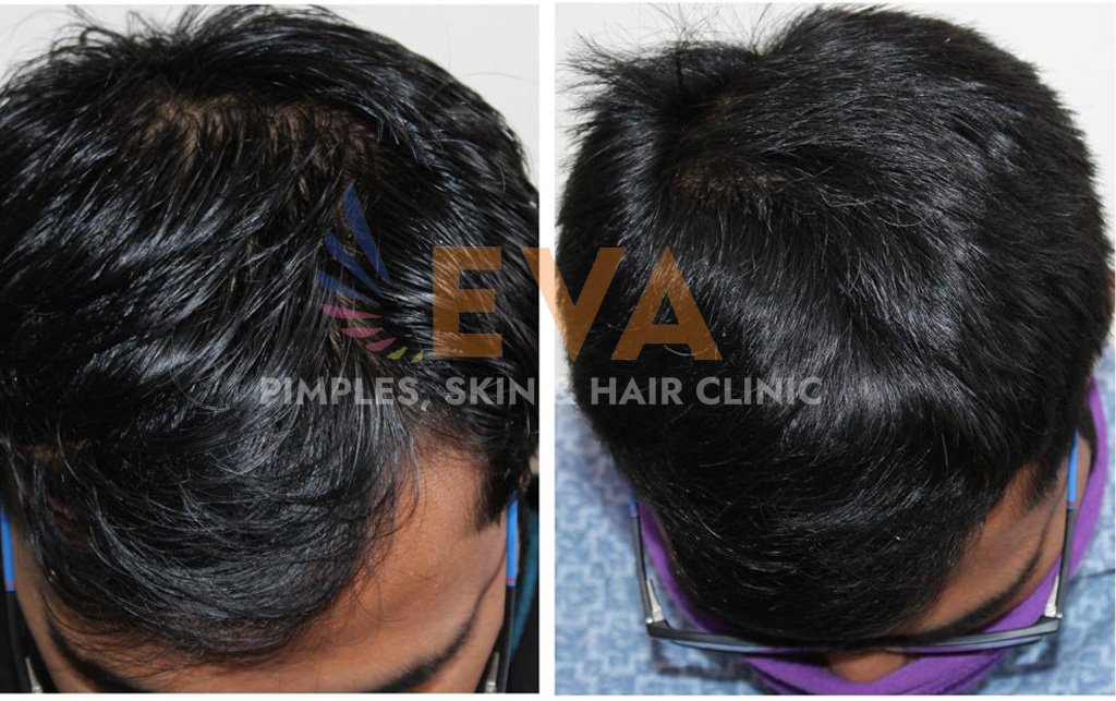 hair loss before after eva skin clinic 8