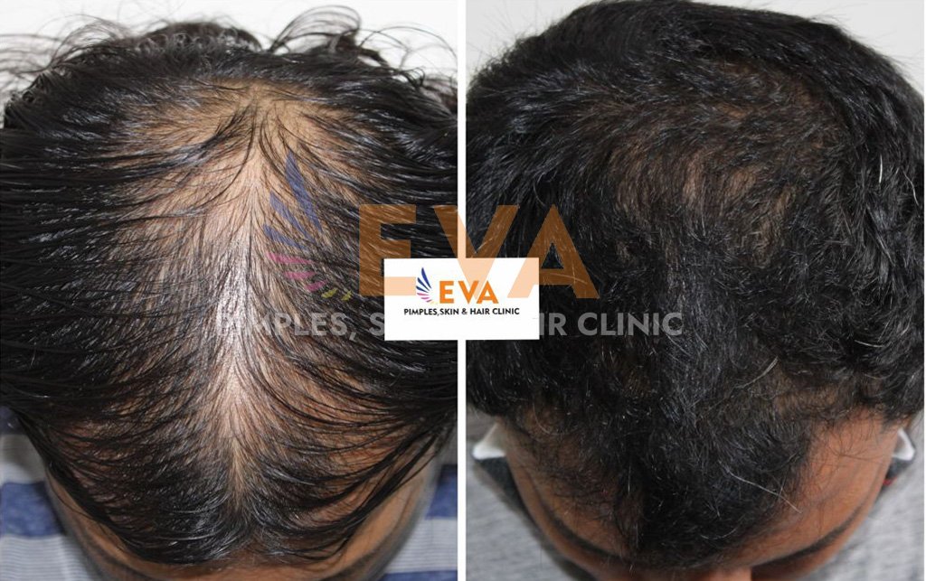 hair loss before after eva skin clinic 9