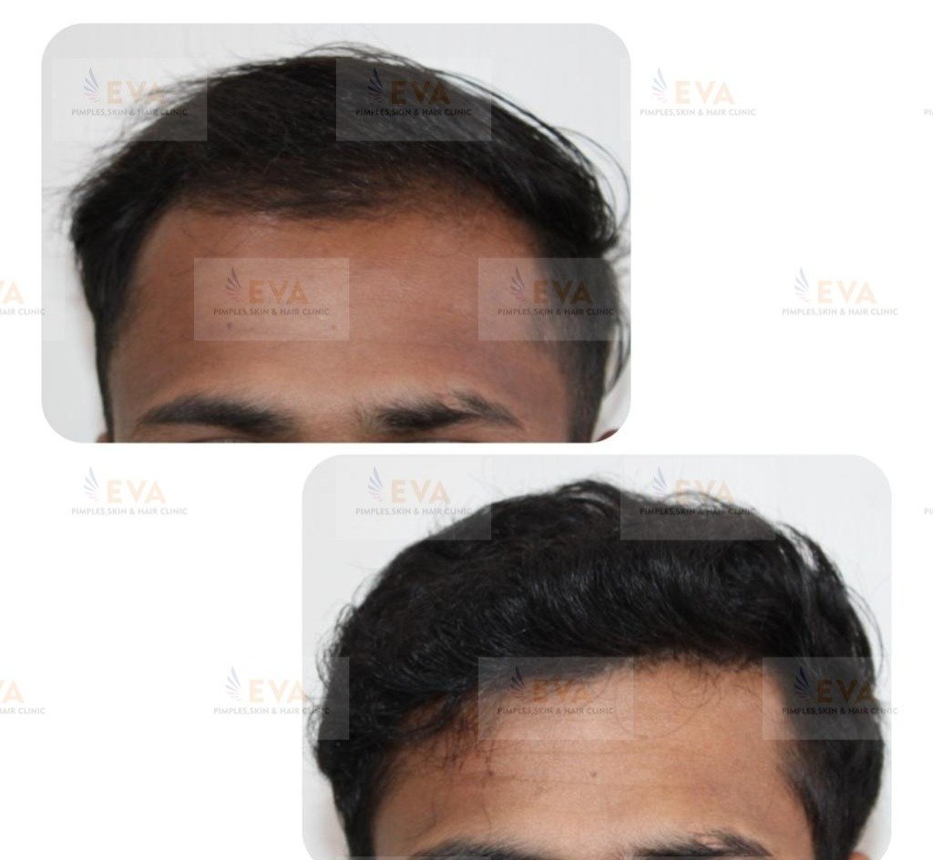 hair-loss-treatment-in-Pune