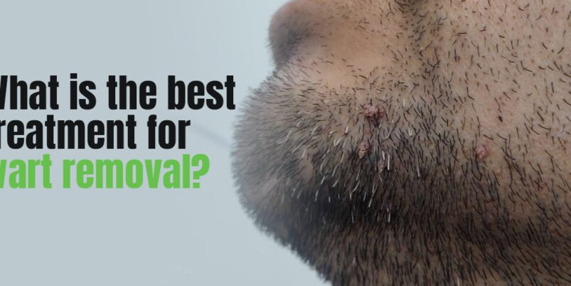 What is the best treatment for wart removal?