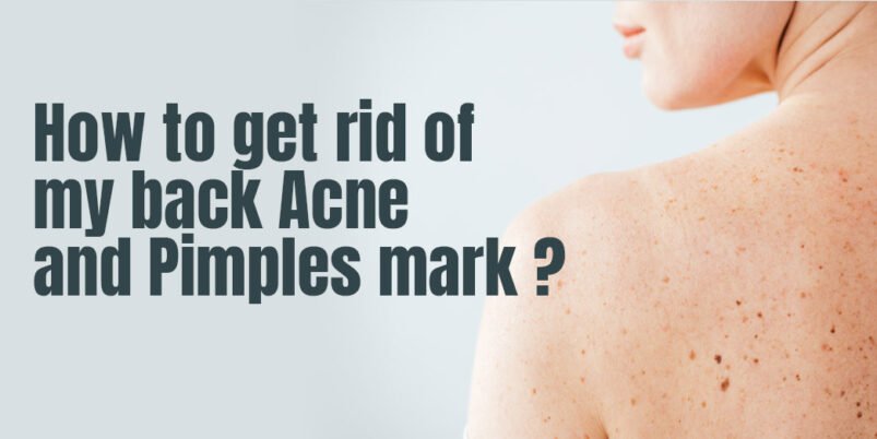 How to get rid of My Back Acne and Pimples mark ?