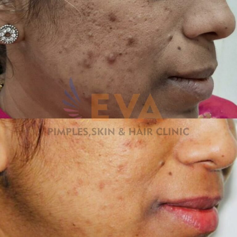 eva clinic acne result