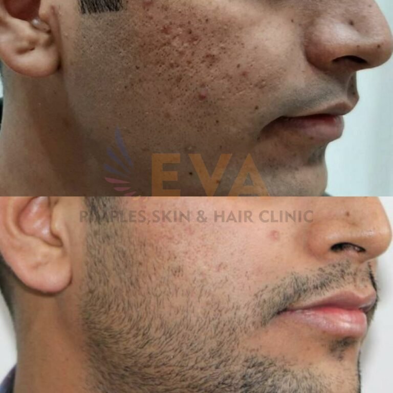eva clinic acne result one