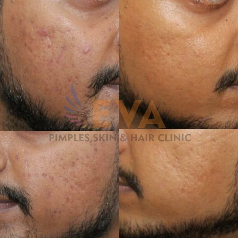 eva clinic acne result two