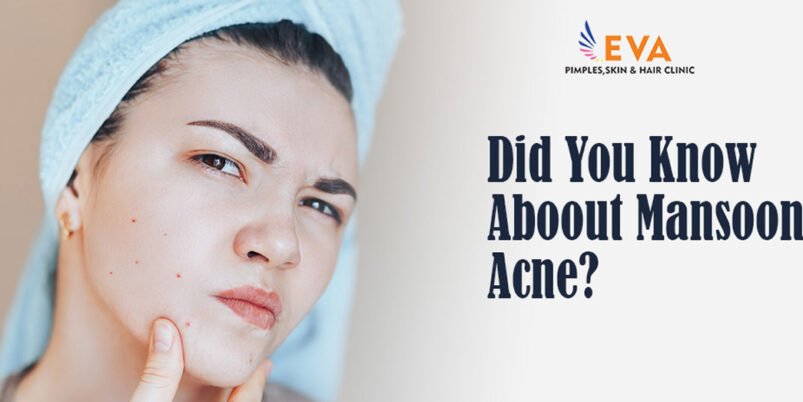 mansoon acne