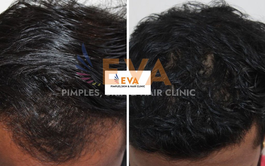 Hair loss Treatment Results - Eva - Pimples, Skin & Hair Clinic