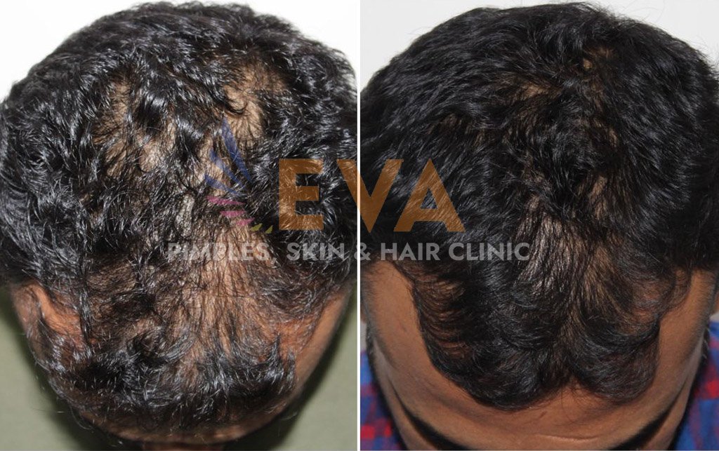 hair loss before after eva skin clinic 7
