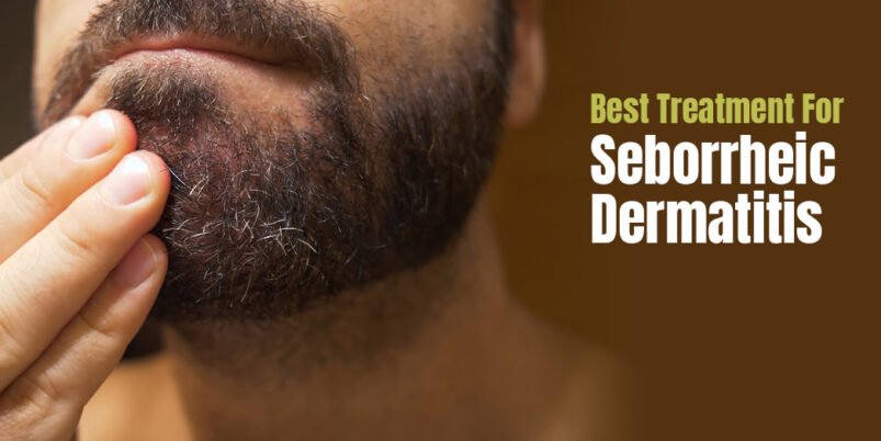 Best treatments for seborrheic dermatitis