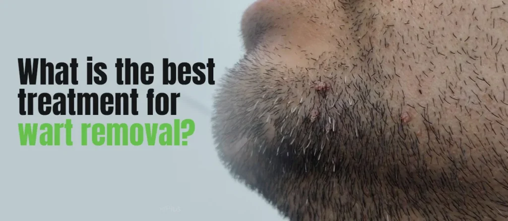 wart removal