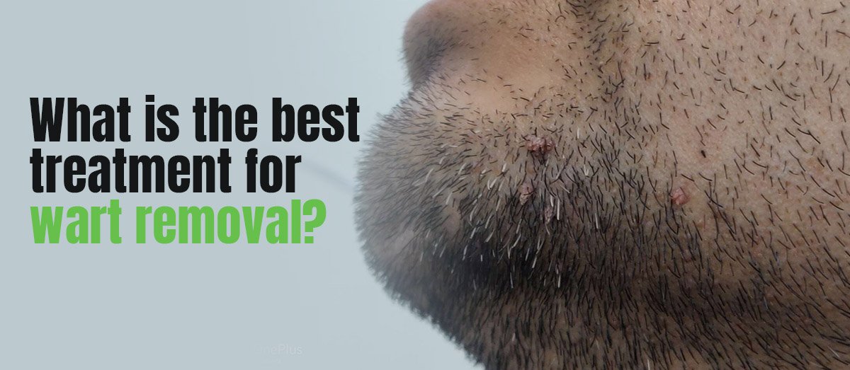 What is the best treatment for wart removal?