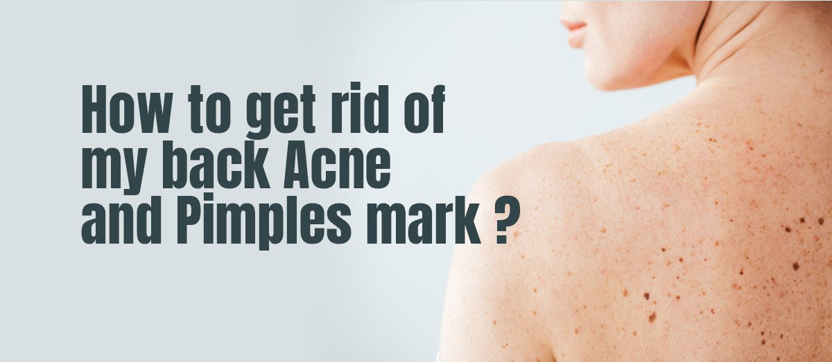 How to get rid of My Back Acne and Pimples mark ?