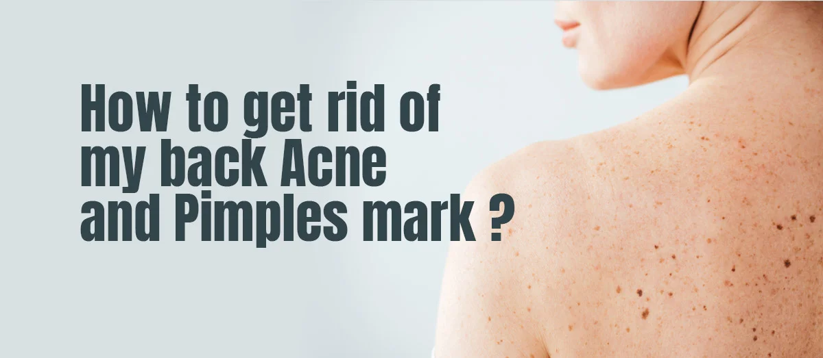 back acne