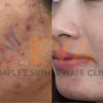 ACNE BEFORE-AFTER