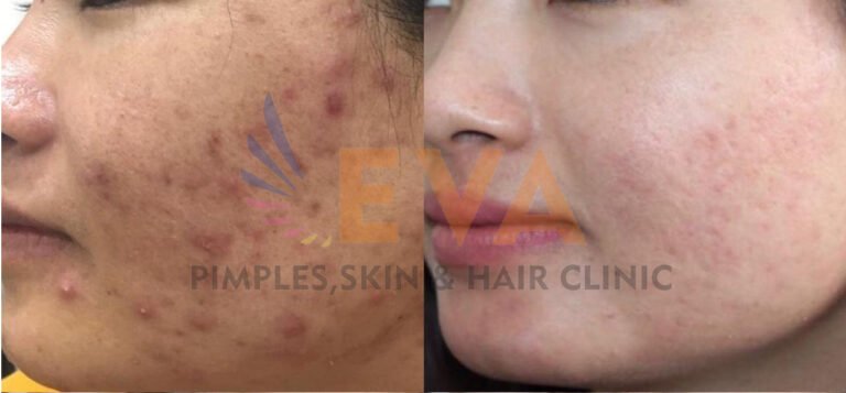ACNE BEFORE-AFTER