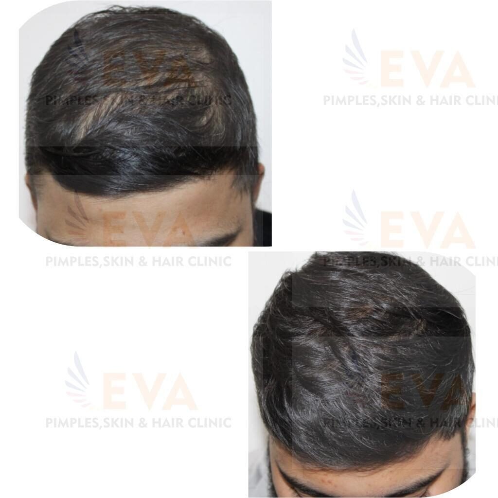 Hair Treatment result of Eva skin clinic