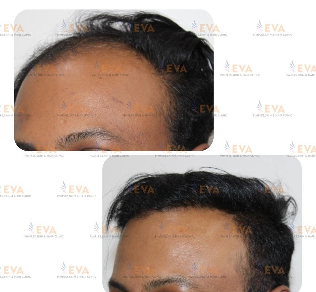 hair-loss-treatment-in-Pune