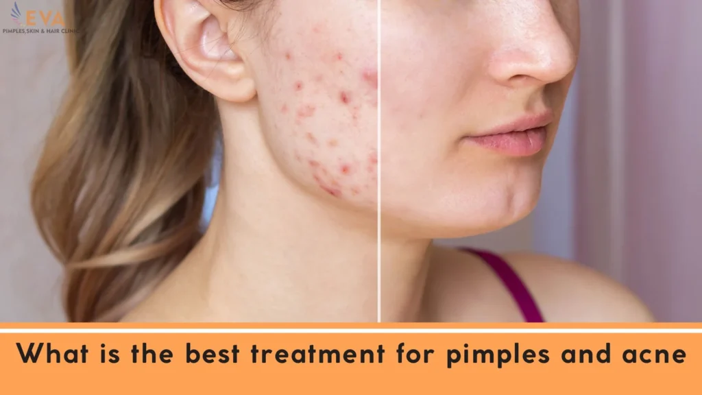 pimple