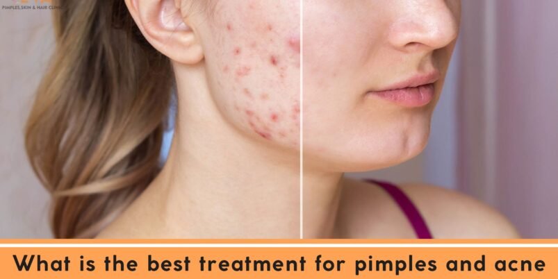 What is the best treatment for pimples and acne?