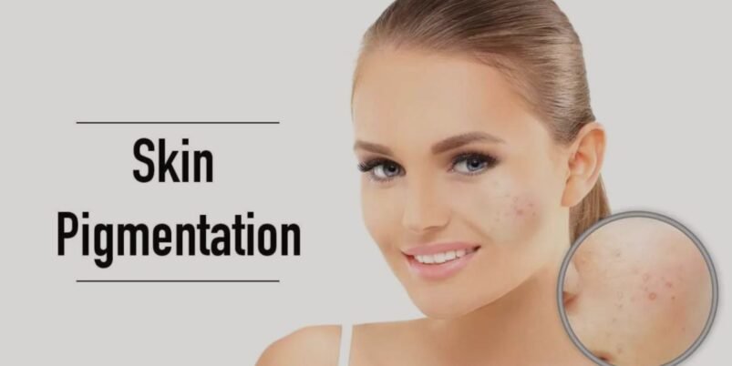 Acne Pigmentation Treatment