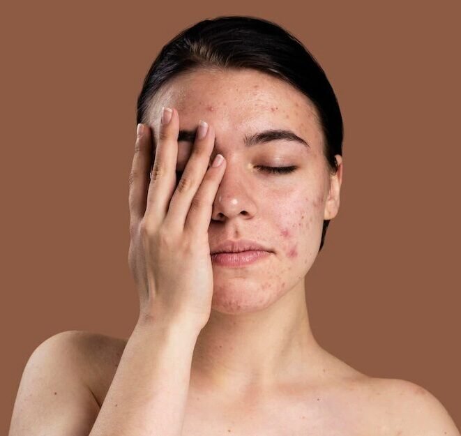 acne scars eva home