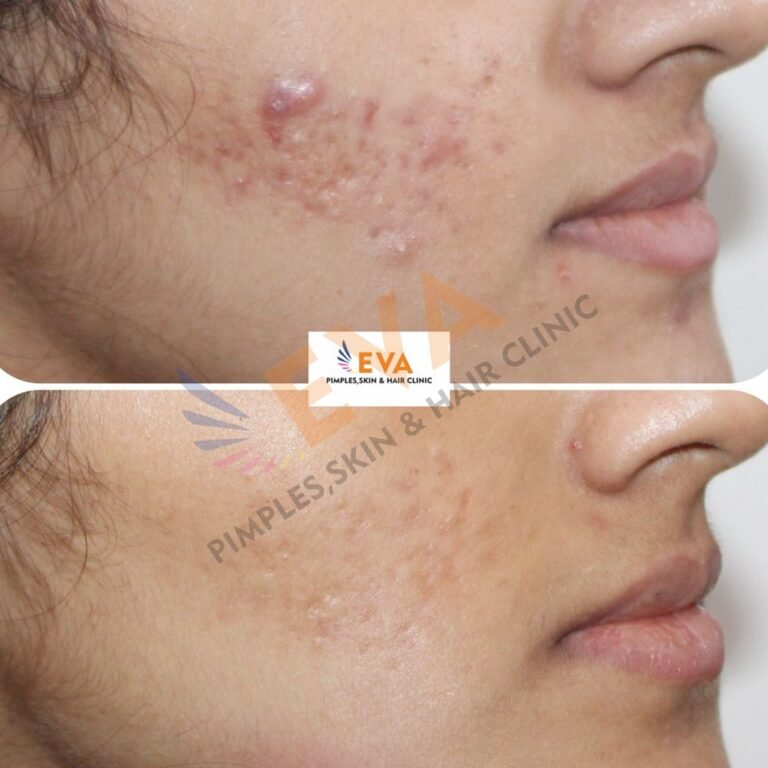 eva clinic acne result