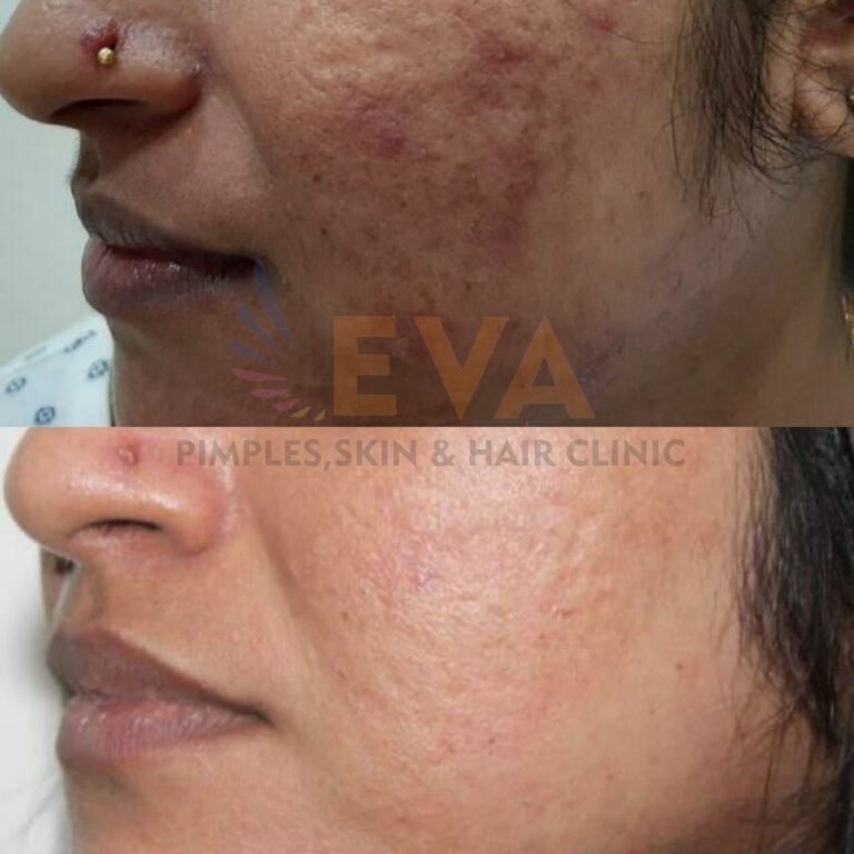 eva clinic acne result three