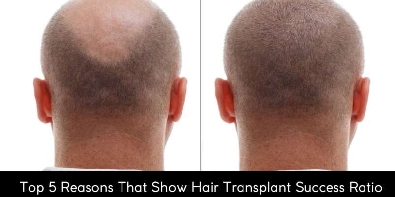Top-5-Reasons-That-Show-Hair-Transplant-Success-Ratio