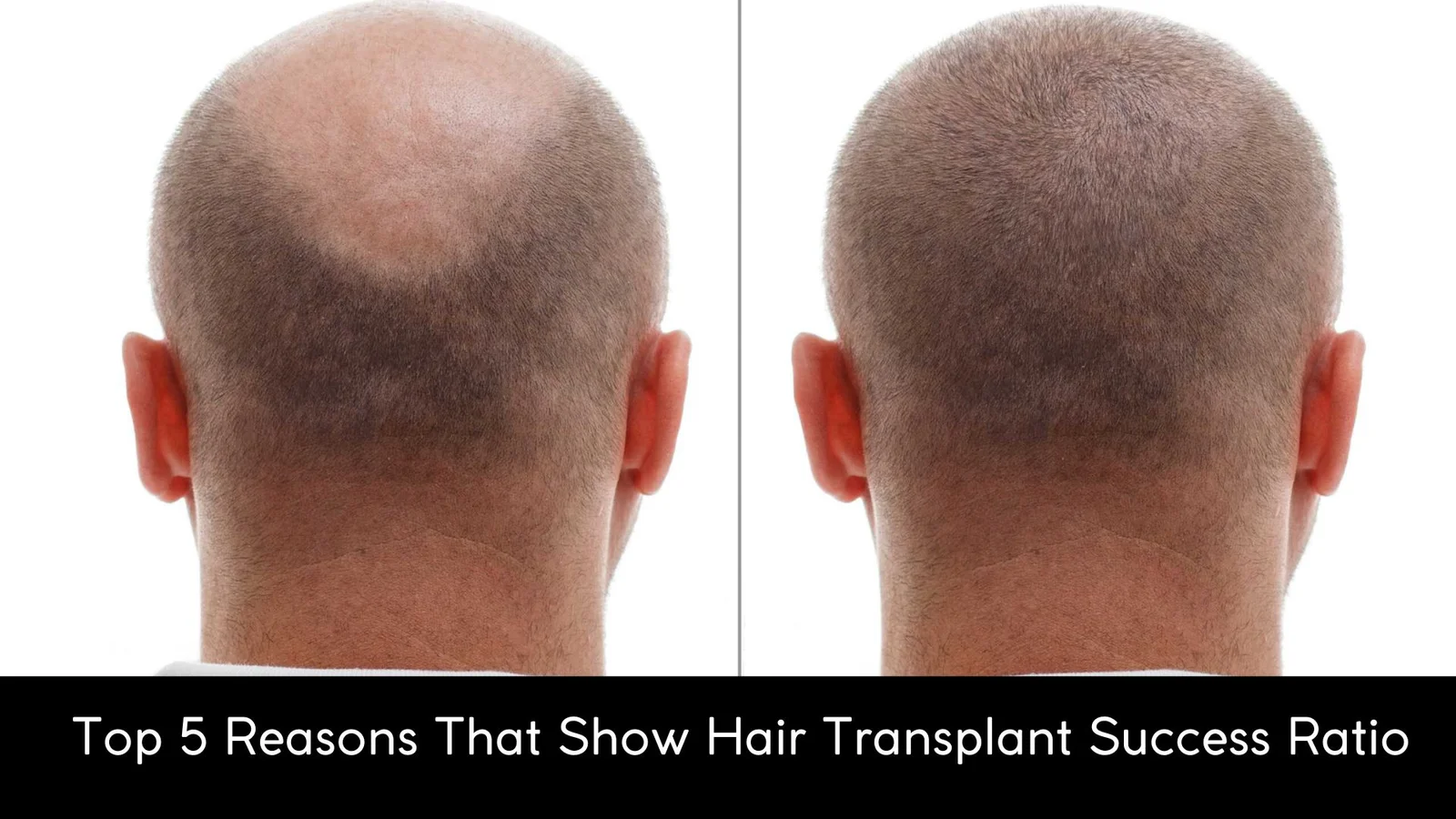 Hair Transplant Success Ratio