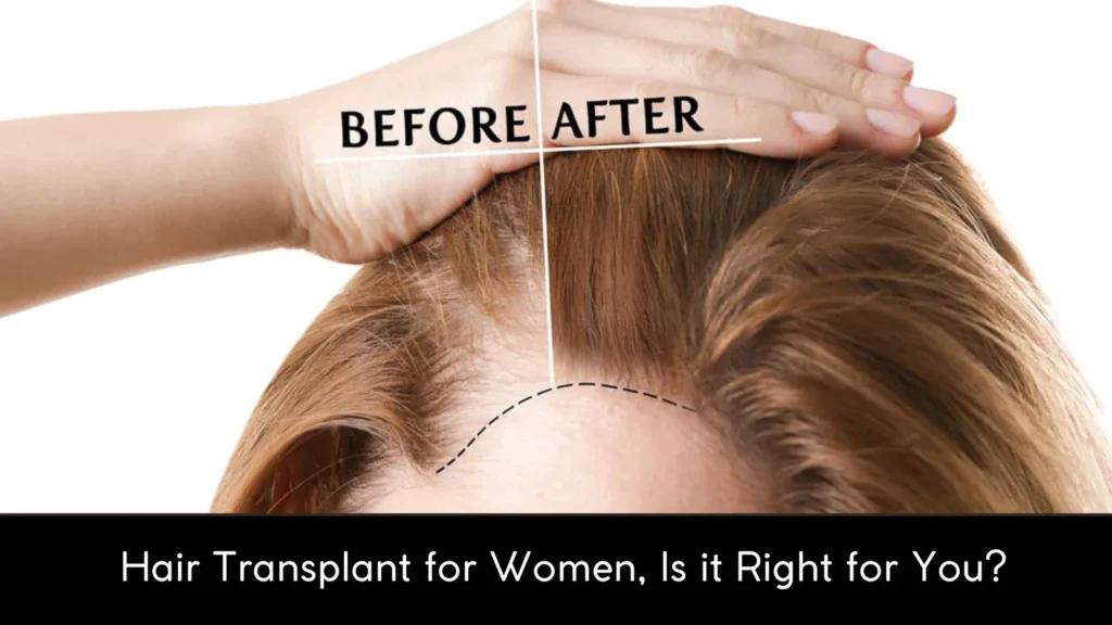 Hair Transplant for Women