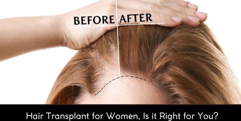 Hair-Transplant-for-Women