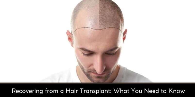 Recovering-from-a-Hair-Transplant