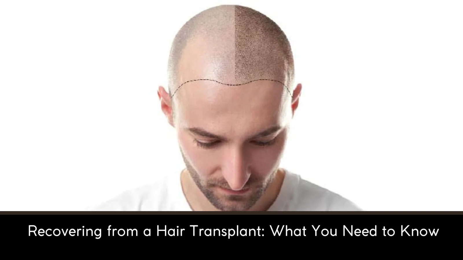Recovering from a Hair Transplant