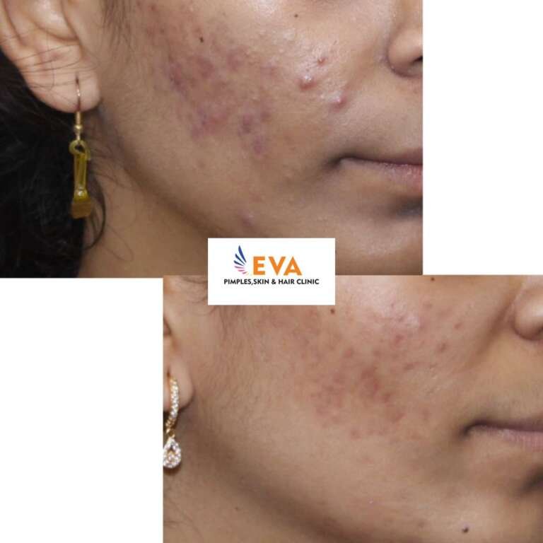 Acne Treatment Results