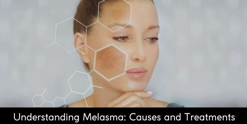 Melasma Treatment in Pune - EVA Skin Clinic