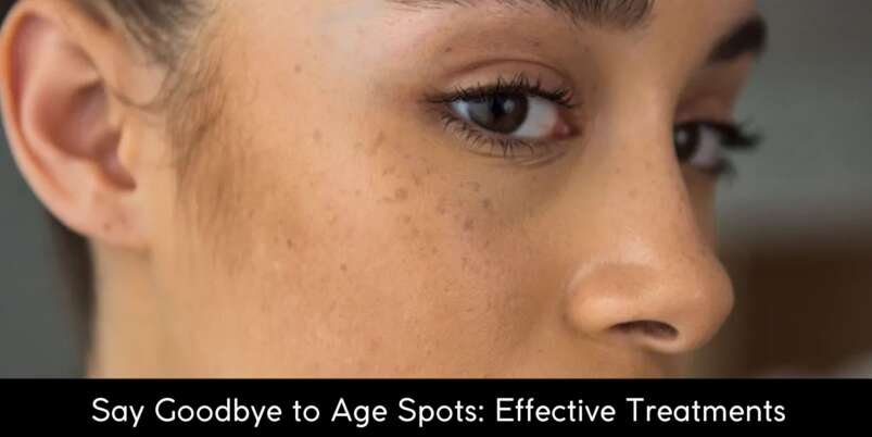 Age-Spots