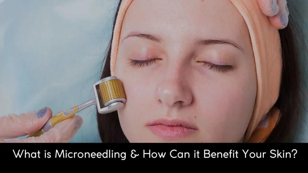 Microneedling
