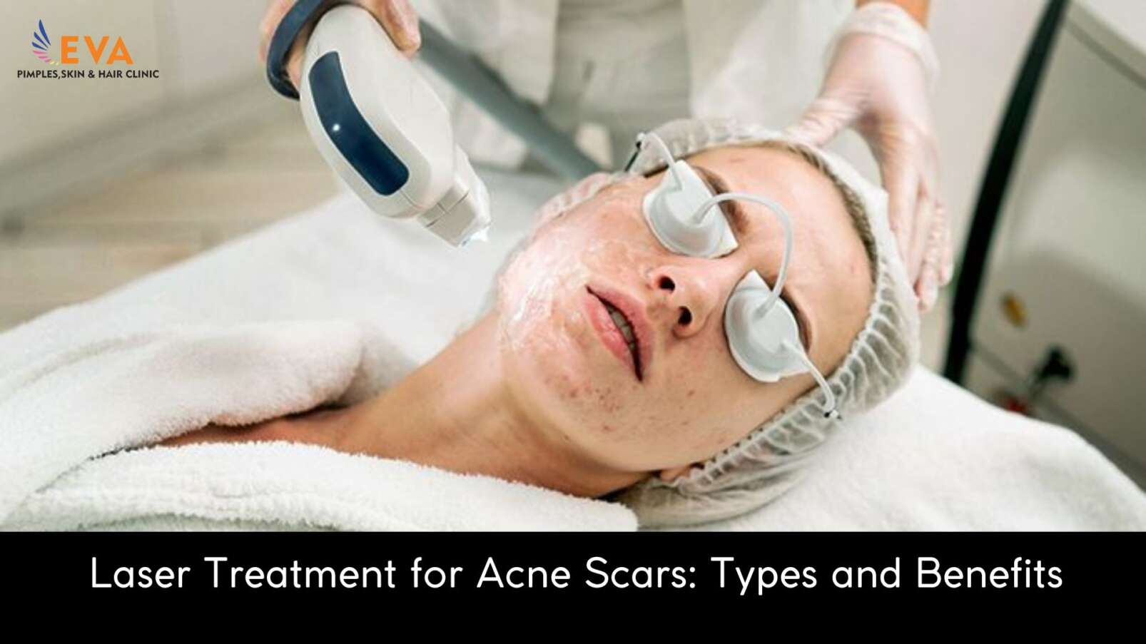 Laser Treatment for Acne Scars Types and Benefits
