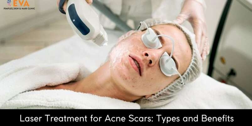 Laser-Treatment-for-Acne-Scars-Banner