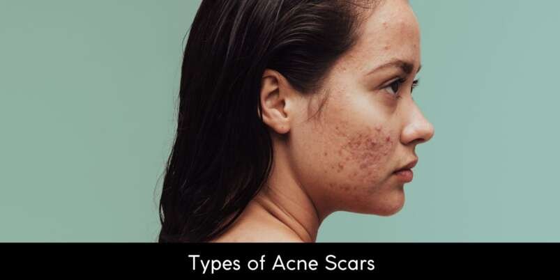 Types of Acne Scars