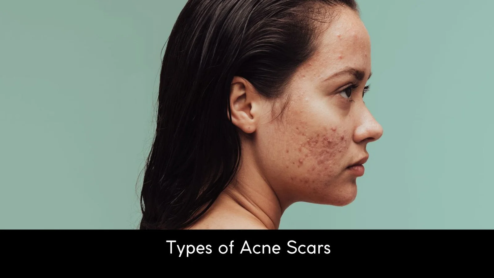 Types of Acne Scars
