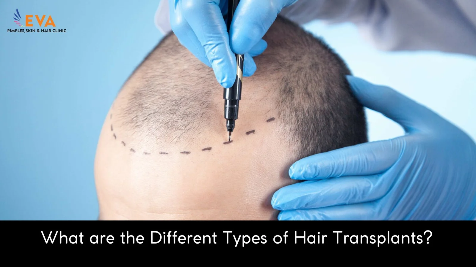 Types of Hair Transplants