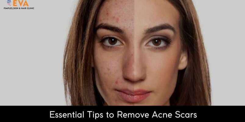 Essential-Tips-to-Remove-Acne-Scars