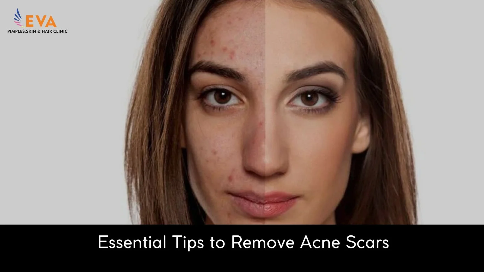 Remove Acne Scars