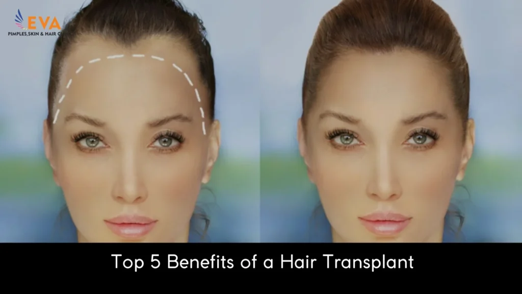 Benefits of a Hair Transplant