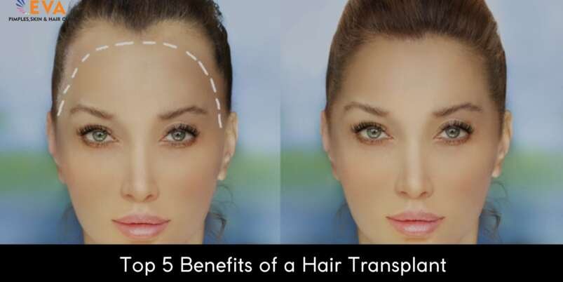 Top-5-Benefits-of-a-Hair-Transplant