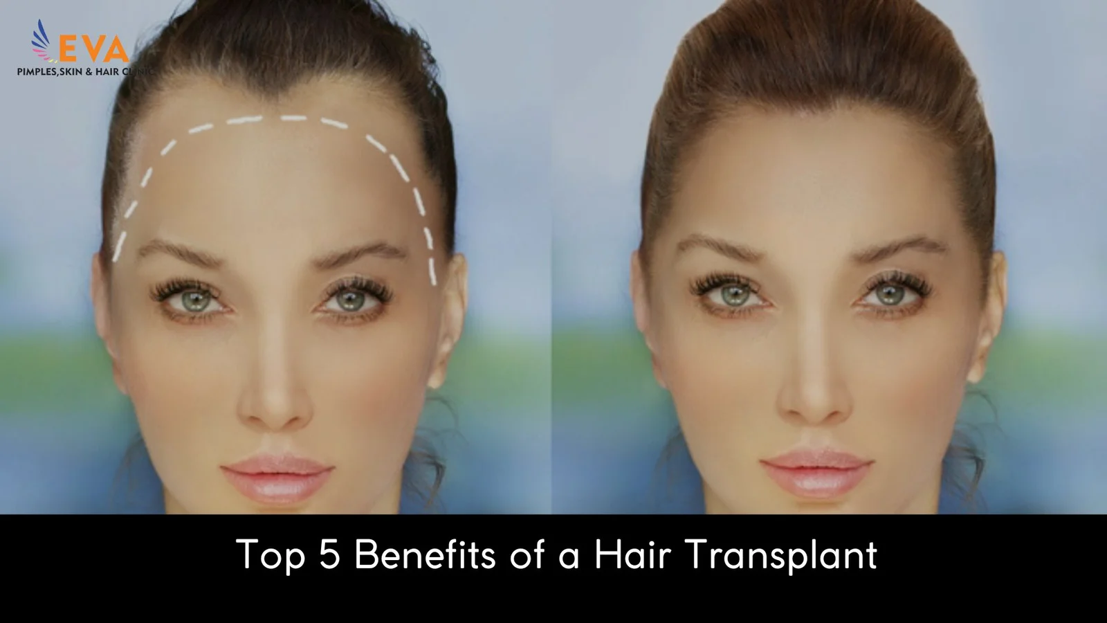 Benefits of a Hair Transplant
