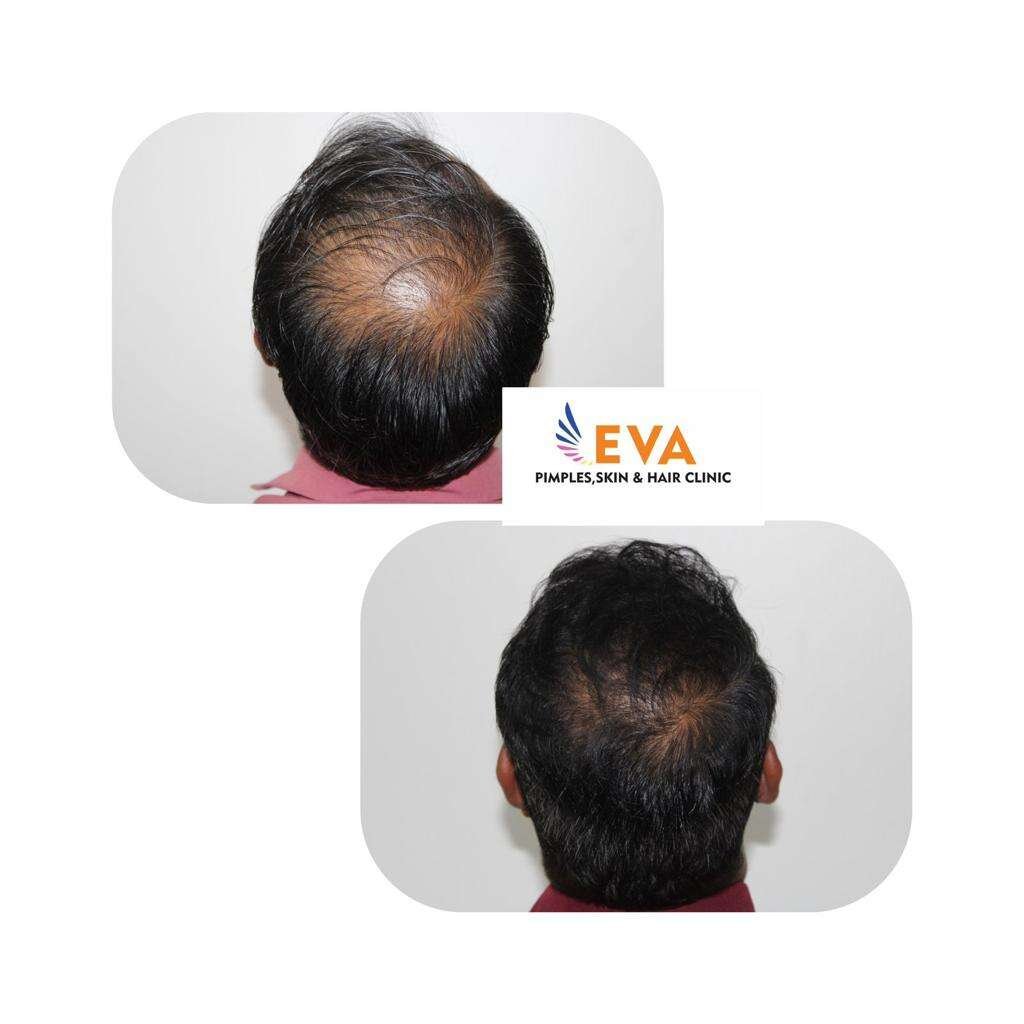 Hair loss Treatment Results