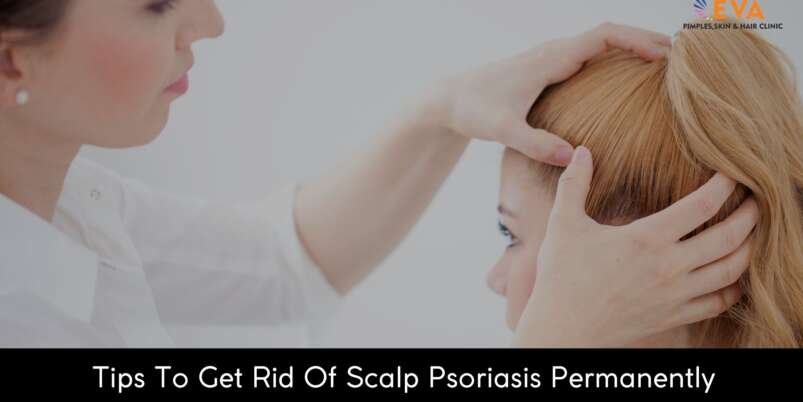 Scalp-Psoriasis