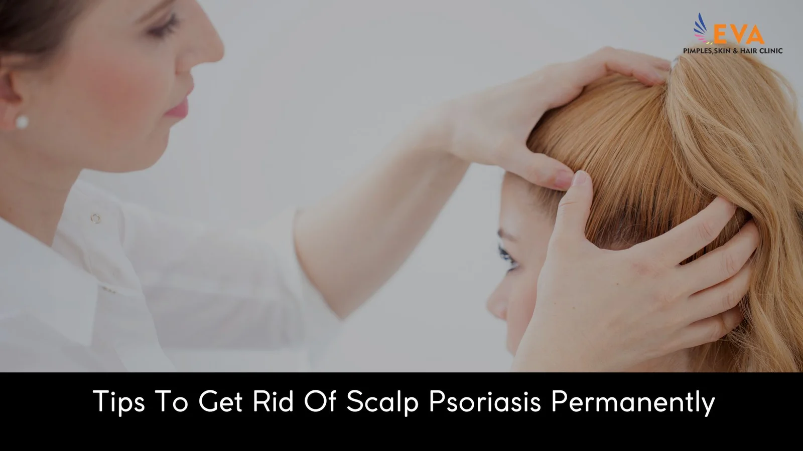 Scalp Psoriasis